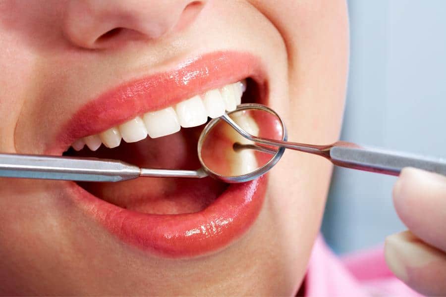 ציפוי שיניים –  מה זה? ולמי זה מתאים?