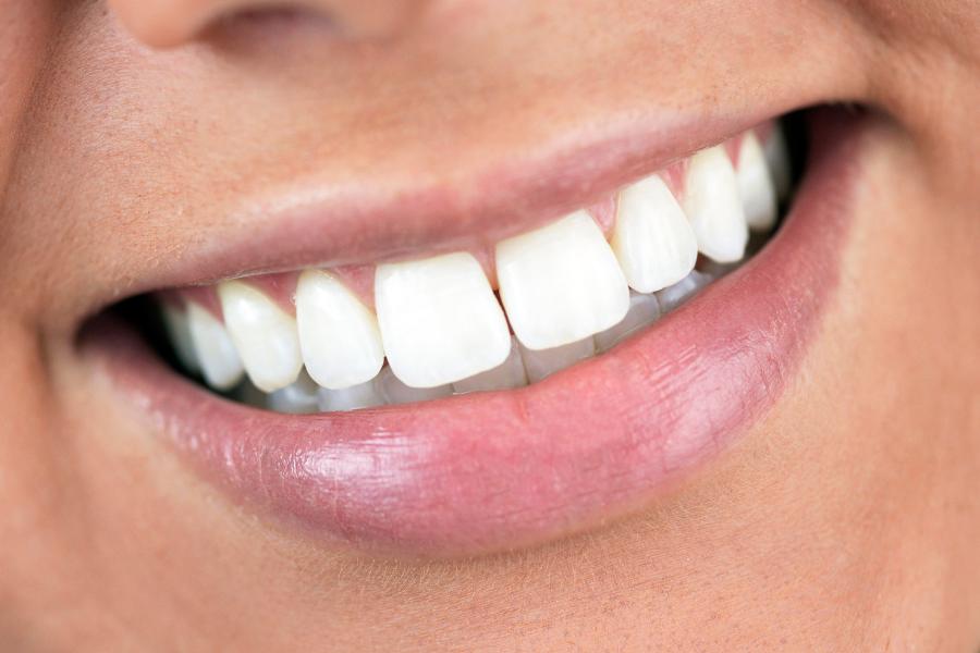 ציפוי שיניים לומינירס – פתרון יעיל וידידותי לחיוך מושלם