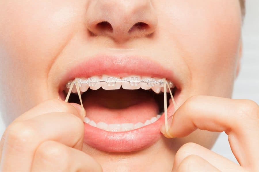 גומיות בשיניים – כל מה שרציתם לדעת ולא היה לכם את מי לשאול