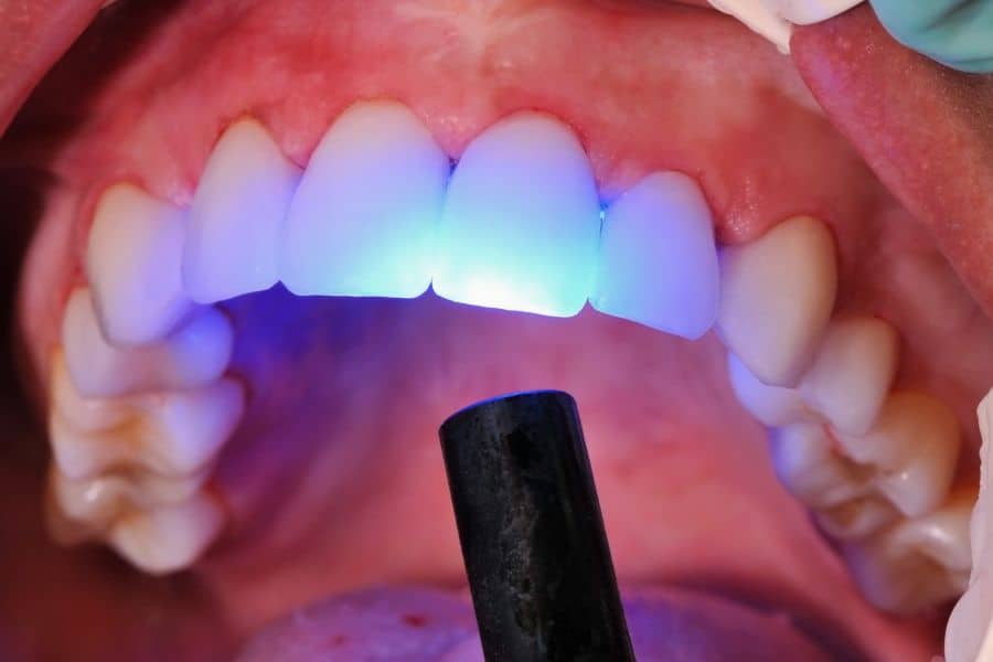 כמה עולה ציפוי שיניים