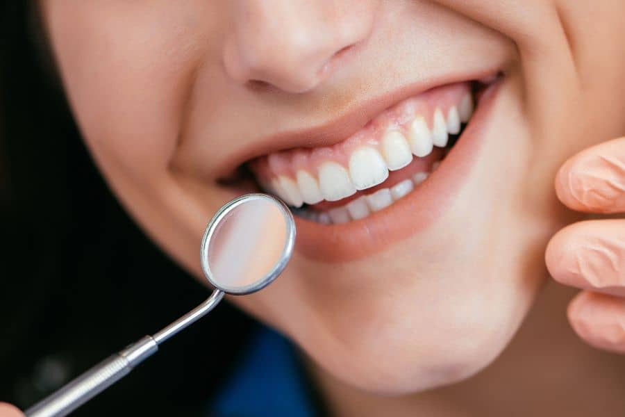 ציפוי שיניים קדמיות